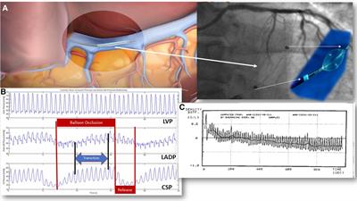 Signs and signals limiting myocardial damage using PICSO: a scoping review decoding paradigm shifts toward a new encounter